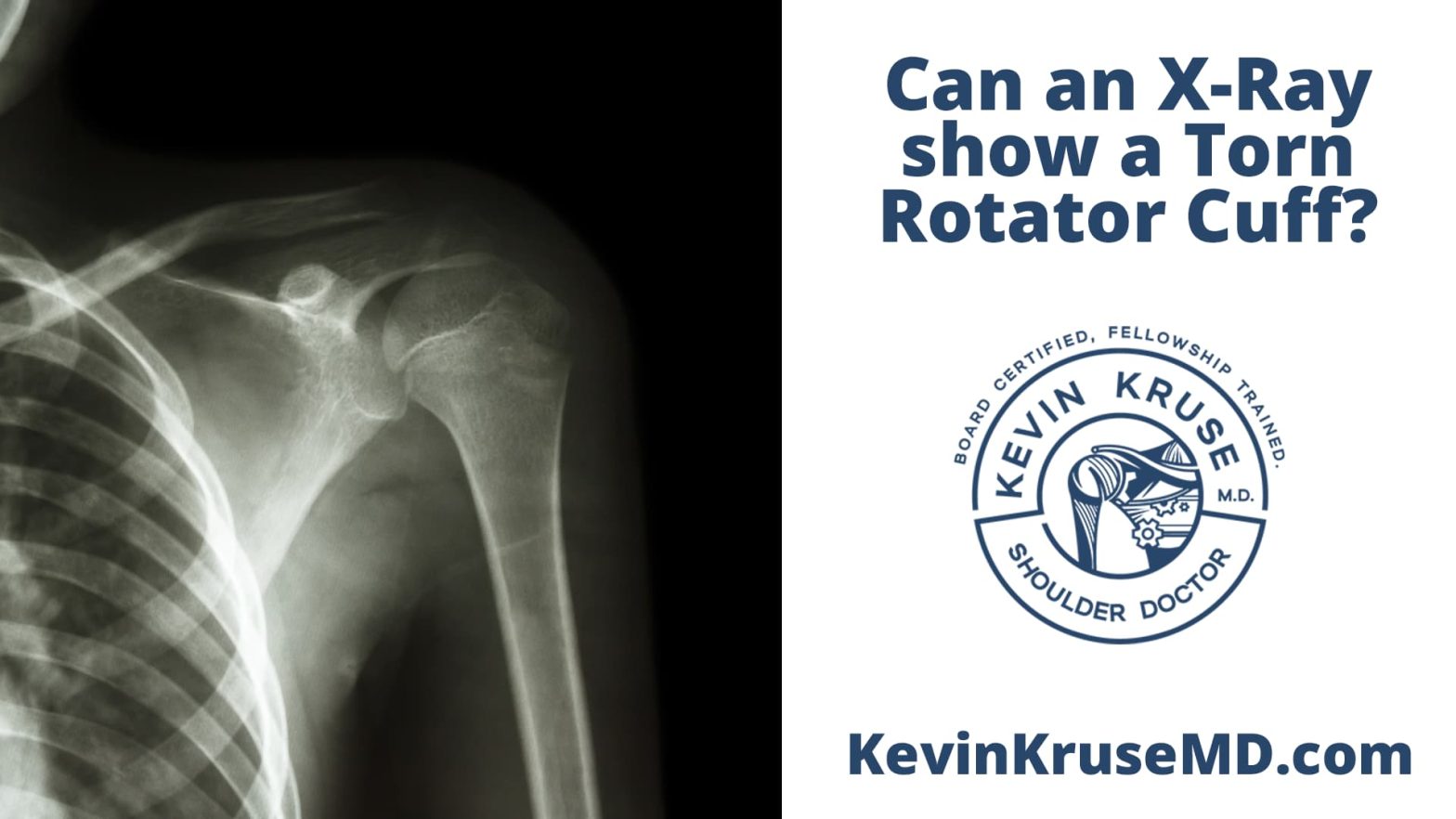 Can X Ray show torn rotator cuff