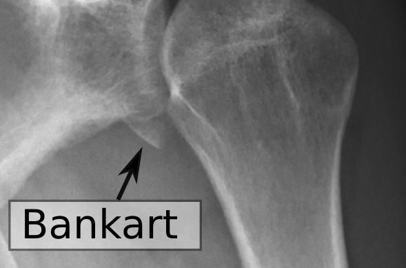 Bony Bankart lesion