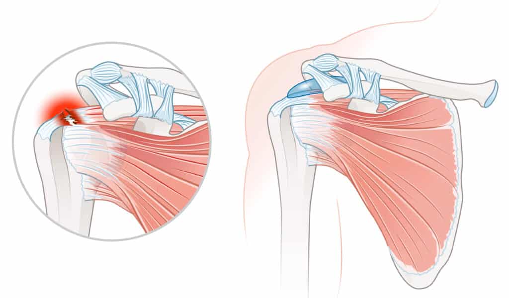 Rotator Cuff Tear