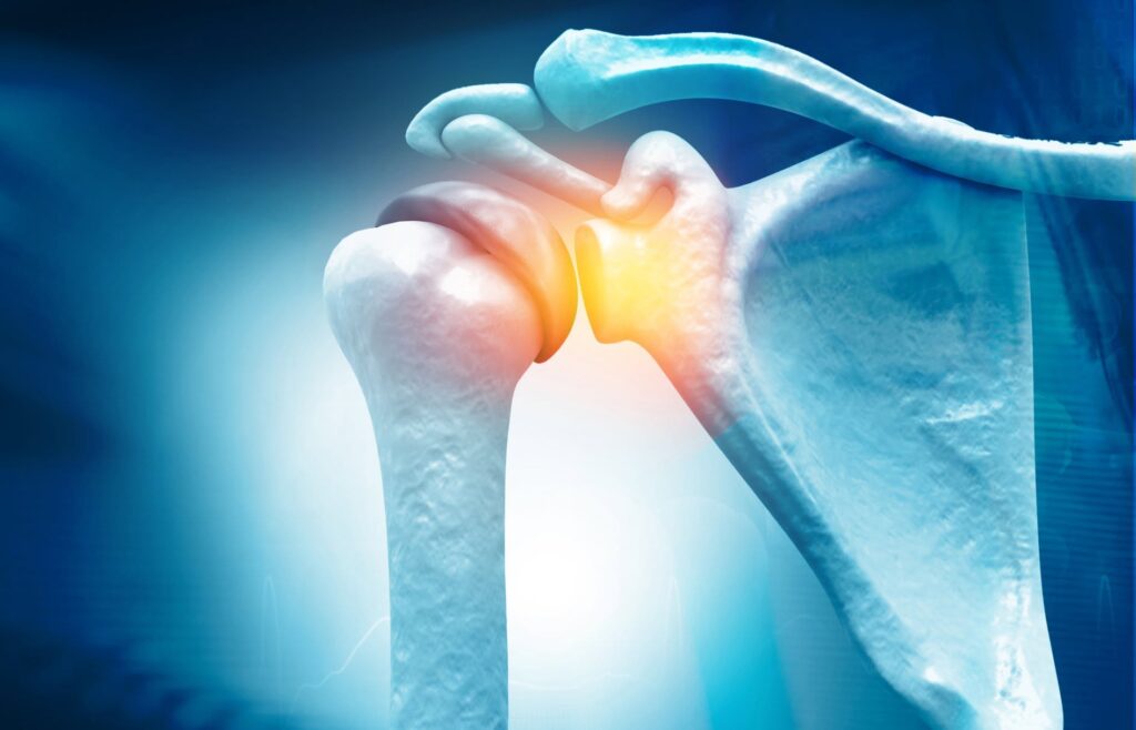 Dislocated Shoulder