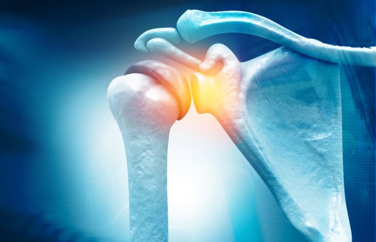 Dislocated Shoulder